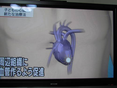 子供の心臓手術　　７月２３日放送済み　　大阪大学