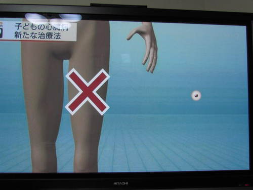子供の心臓手術　　７月２３日放送済み　　大阪大学