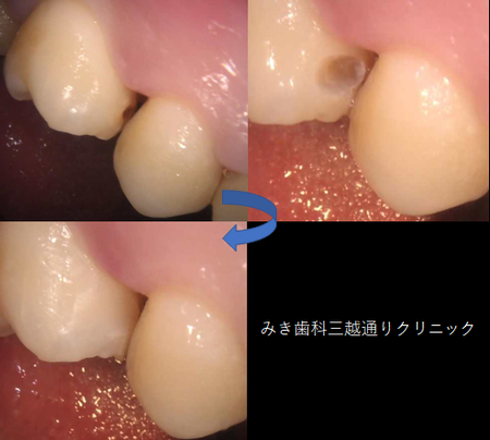 虫歯治療の一例